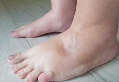 पैरों में बार-बार होने वाली सूजन को न करें नजरअंदाज, हो सकता है दिल की बीमारी का संकेत